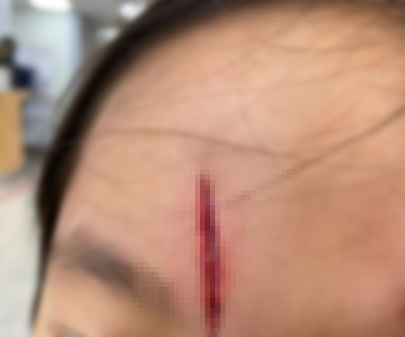 키즈카페에서 놀이기구에 맞아 이마에 상처를 입은 A씨의 자녀 ⓒ보배드림