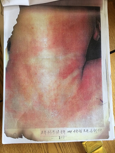 목졸림 흔적