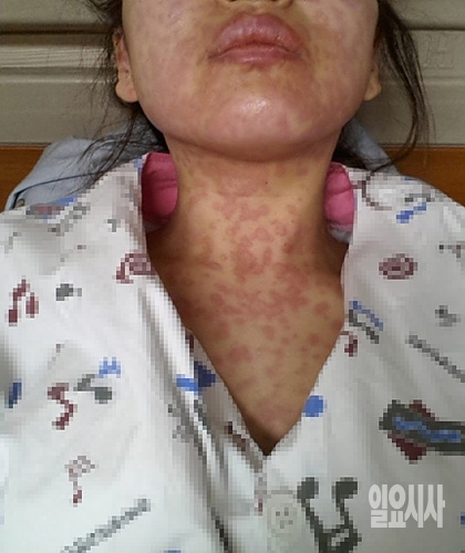 이주영(가명)씨가 겪은 다형홍반 증상들