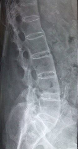 강직성 척추염 환자의 X-ray 사진
