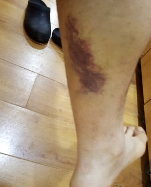 정강이에 멍이 든 전북대 병원 피해자