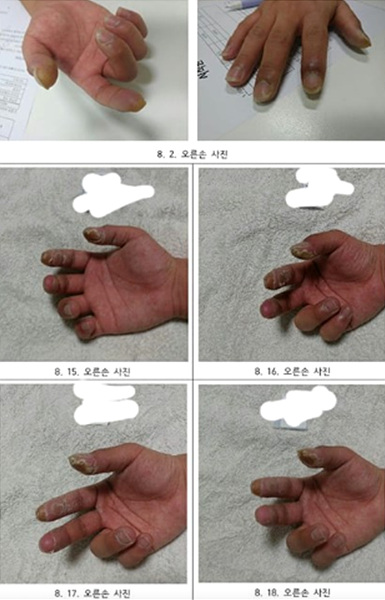 피폭 피해자 ⓒ반올림 ▲ 피폭 피해자 ⓒ반올림
